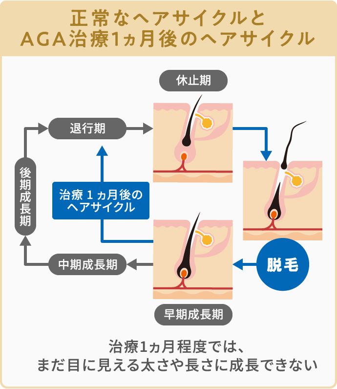 AGA治療で「効果がない」と後悔する７つの原因と満足する人の特徴