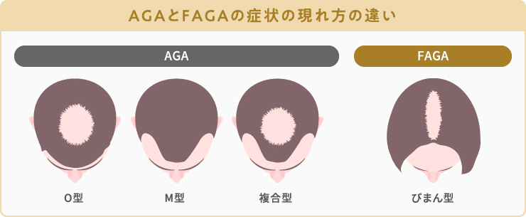 FAGAとAGAの症状の現れ方の違い