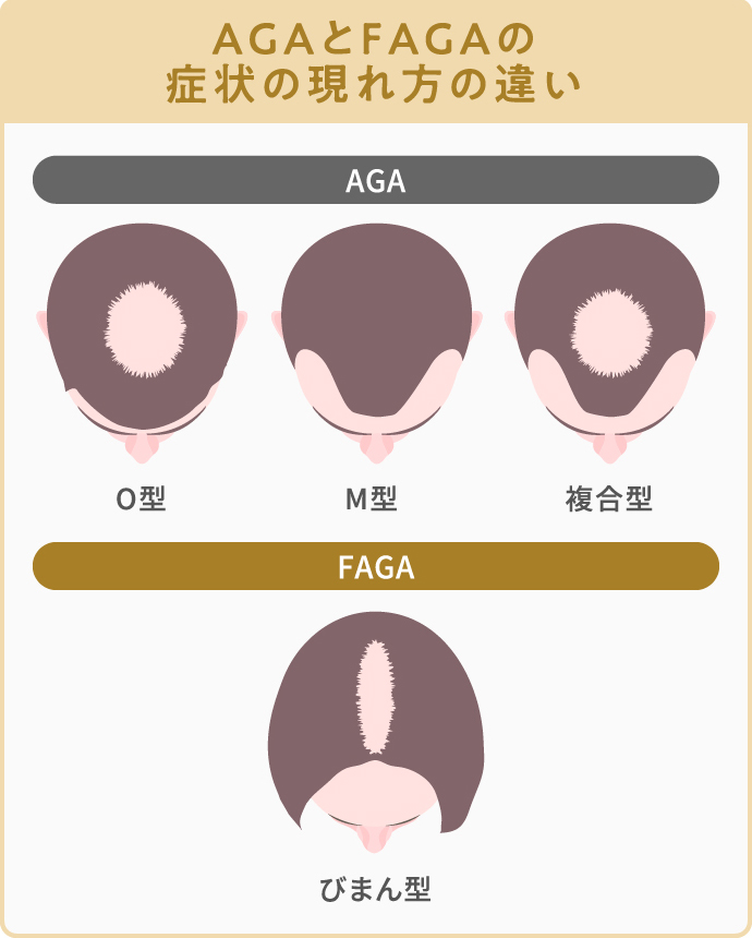 FAGAとAGAの症状の現れ方の違い