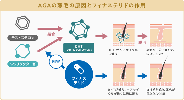 AGAによる薄毛の原因とフィナステリドの作用