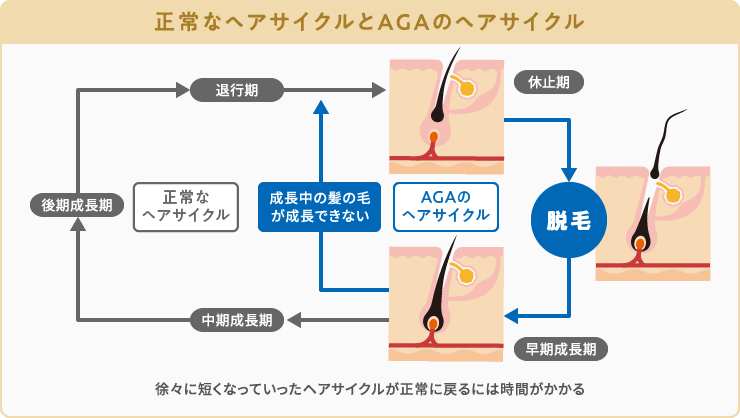 正常なヘアサイクルとAGAで短縮したヘアサイクルの違い