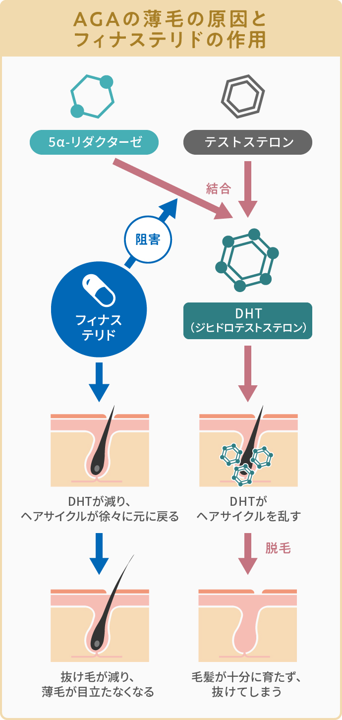 AGAによる薄毛の原因とフィナステリドの作用