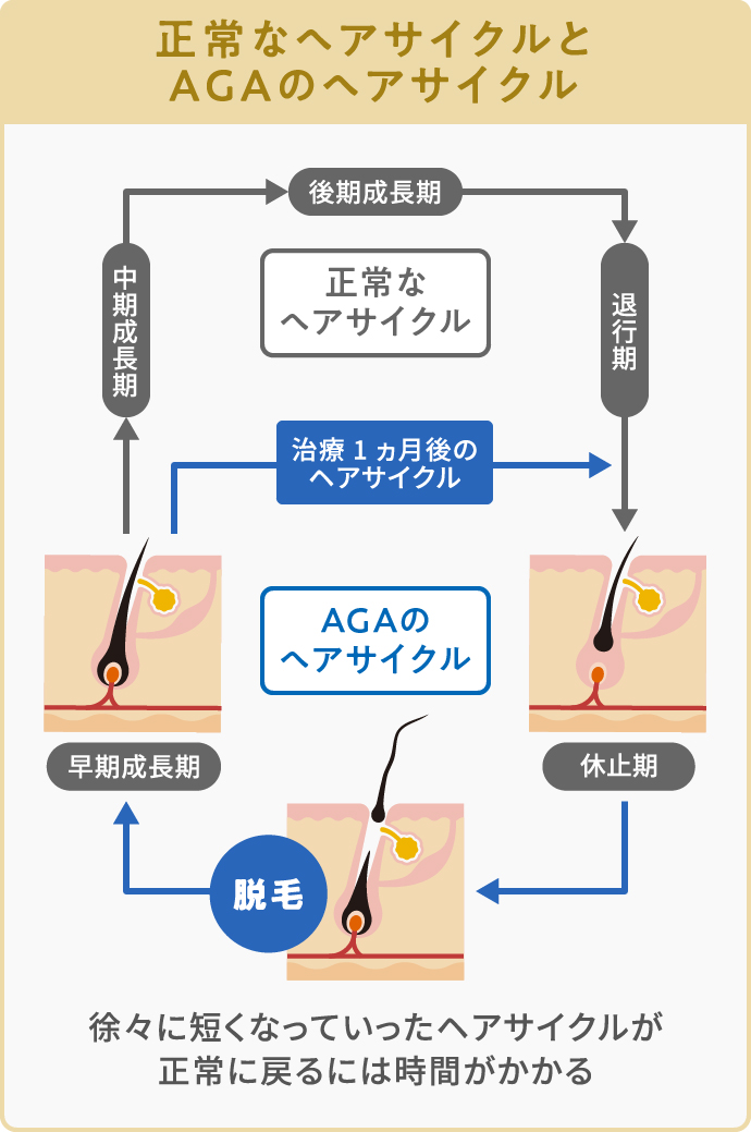 正常なヘアサイクルとAGAで短縮したヘアサイクルの違い