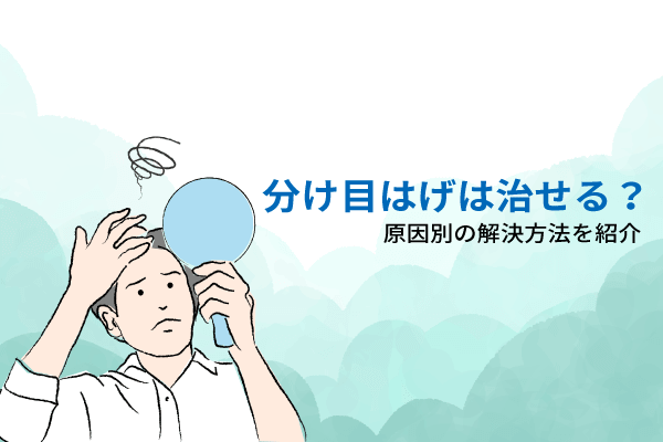 分け目はげは治せる？原因別の解決方法を紹介